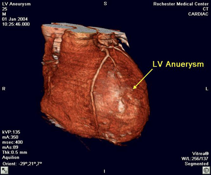 Left ventricular aneurysm(LV)